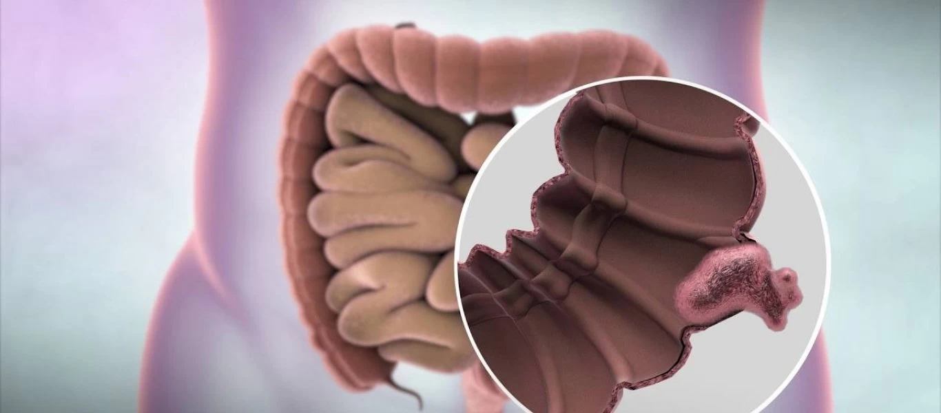 Καρκίνος παχέος εντέρου & ορθού: Τα συμπτώματα που δεν πρέπει να αγνοήσετε